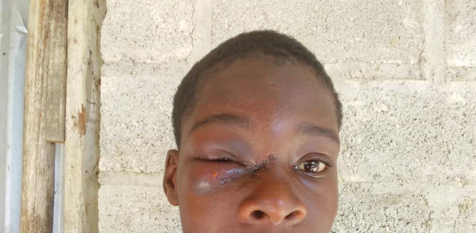 Joven de 18 años denuncia agresión en un ojo por agentes policiales durante requisa en San Luis